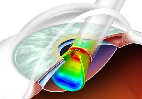 Computational modeling of the intraocular lens.